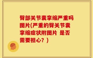 臀部关节囊挛缩严重吗图片(严重的臀关节囊挛缩症状附图片 是否需要担心？)
