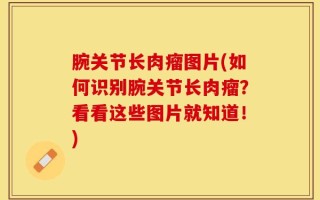腕关节长肉瘤图片(如何识别腕关节长肉瘤？看看这些图片就知道！)
