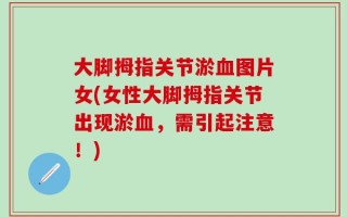 大脚拇指关节淤血图片女(女性大脚拇指关节出现淤血，需引起注意！)