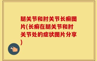 腿关节和肘关节长癣图片(长癣在腿关节和肘关节处的症状图片分享)