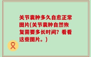 关节囊肿多久自愈正常图片(关节囊肿自然恢复需要多长时间？看看这些图片。)