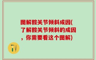 图解髋关节倾斜成因(了解髋关节倾斜的成因，你需要看这个图解)