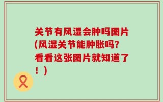关节有风湿会肿吗图片(风湿关节能肿胀吗？看看这张图片就知道了！)