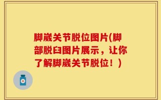 脚崴关节脱位图片(脚部脱臼图片展示，让你了解脚崴关节脱位！)