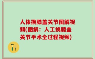 人体换膝盖关节图解视频(图解：人工换膝盖关节手术全过程视频)