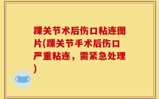 踝关节术后伤口粘连图片(踝关节手术后伤口严重粘连，需紧急处理)