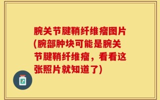 腕关节腱鞘纤维瘤图片(腕部肿块可能是腕关节腱鞘纤维瘤，看看这张照片就知道了)