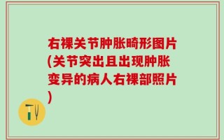 右裸关节肿胀畸形图片(关节突出且出现肿胀变异的病人右裸部照片)