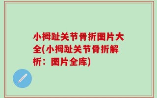 小拇趾关节骨折图片大全(小拇趾关节骨折解析：图片全库)
