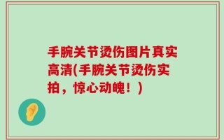 手腕关节烫伤图片真实高清(手腕关节烫伤实拍，惊心动魄！)