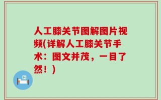 人工膝关节图解图片视频(详解人工膝关节手术：图文并茂，一目了然！)