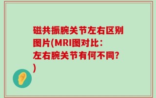 磁共振腕关节左右区别图片(MRI图对比：左右腕关节有何不同？)