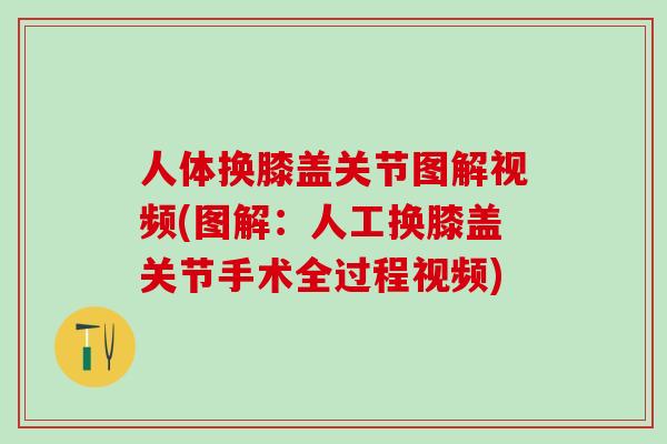 人体换膝盖关节图解视频(图解:人工换膝盖关节手术全过程视频)-第1张图片-氨糖科普网 人体换膝盖关节图解视频(图解:人工换膝盖关节手术全过程视频)-第1张图片-氨糖科普网