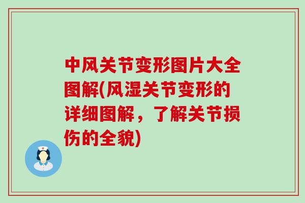 中风关节变形图片大全图解(风湿关节变形的详细图解,了解关节损伤的全貌)-第1张图片-氨糖科普网 中风关节变形图片大全图解(风湿关节变形的详细图解,了解关节损伤的全貌)-第1张图片-氨糖科普网