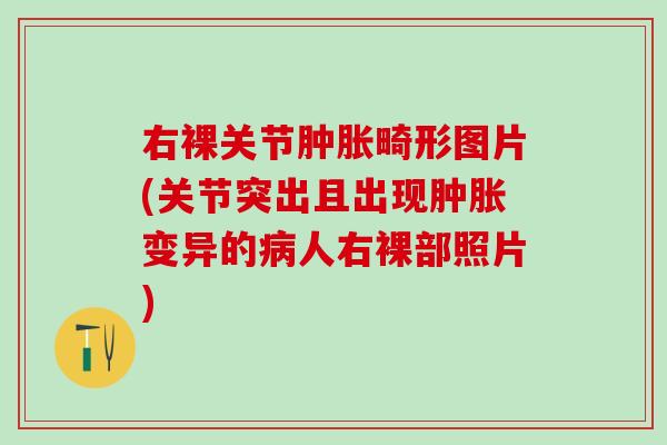 右裸关节肿胀畸形图片(关节突出且出现肿胀变异的病人右裸部照片)-第1张图片-氨糖科普网 右裸关节肿胀畸形图片(关节突出且出现肿胀变异的病人右裸部照片)-第1张图片-氨糖科普网