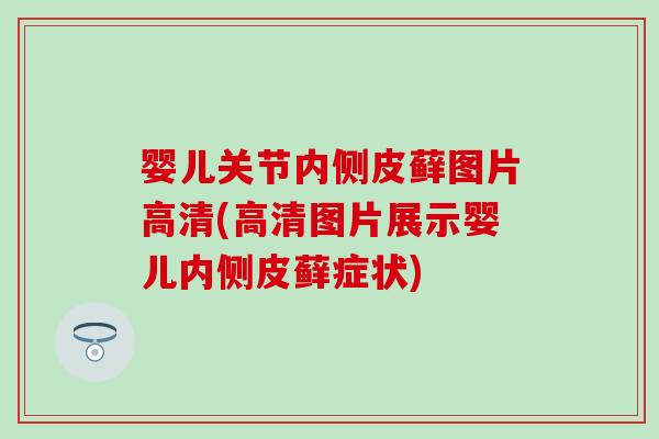 婴儿关节内侧皮藓图片高清(高清图片展示婴儿内侧皮藓症状)-第1张图片-氨糖科普网 婴儿关节内侧皮藓图片高清(高清图片展示婴儿内侧皮藓症状)-第1张图片-氨糖科普网