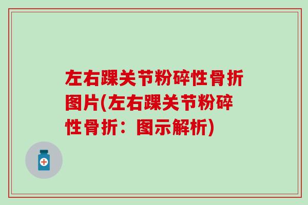 左右踝关节粉碎性骨折图片(左右踝关节粉碎性骨折：图示解析)-第1张图片-氨糖科普网