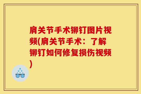 肩关节手术铆钉图片视频(肩关节手术：了解铆钉如何修复损伤视频)-第1张图片-氨糖科普网