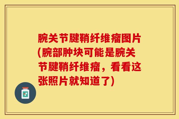 腕关节腱鞘纤维瘤图片(腕部肿块可能是腕关节腱鞘纤维瘤,看看这张照片就知道了)-第1张图片-氨糖科普网 腕关节腱鞘纤维瘤图片(腕部肿块可能是腕关节腱鞘纤维瘤,看看这张照片就知道了)-第1张图片-氨糖科普网