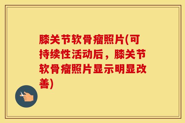 膝关节软骨瘤照片(可持续性活动后,膝关节软骨瘤照片显示明显改善)-第1张图片-氨糖科普网 膝关节软骨瘤照片(可持续性活动后,膝关节软骨瘤照片显示明显改善)-第1张图片-氨糖科普网