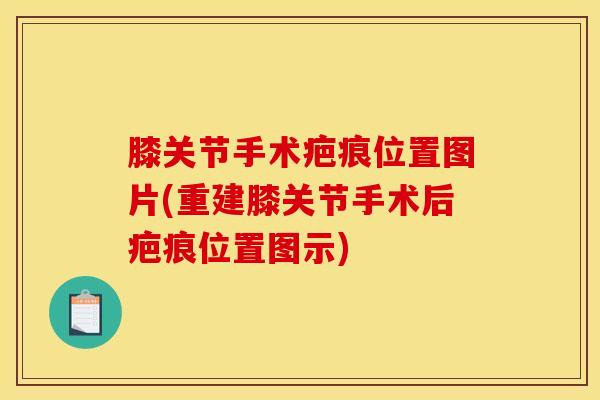 膝关节手术疤痕位置图片(重建膝关节手术后疤痕位置图示)-第1张图片-氨糖科普网 膝关节手术疤痕位置图片(重建膝关节手术后疤痕位置图示)-第1张图片-氨糖科普网
